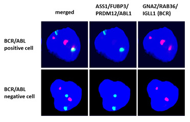 Translokácia génov BCR a ABL pozorovaná fluorescenčnou in-situ hybridizáciou.