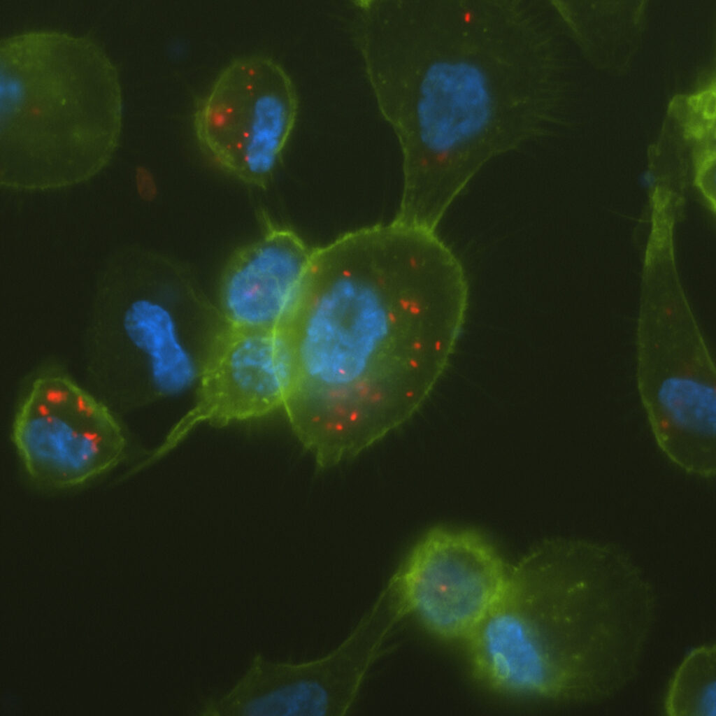 Infekcia Coxiellou burnetii.